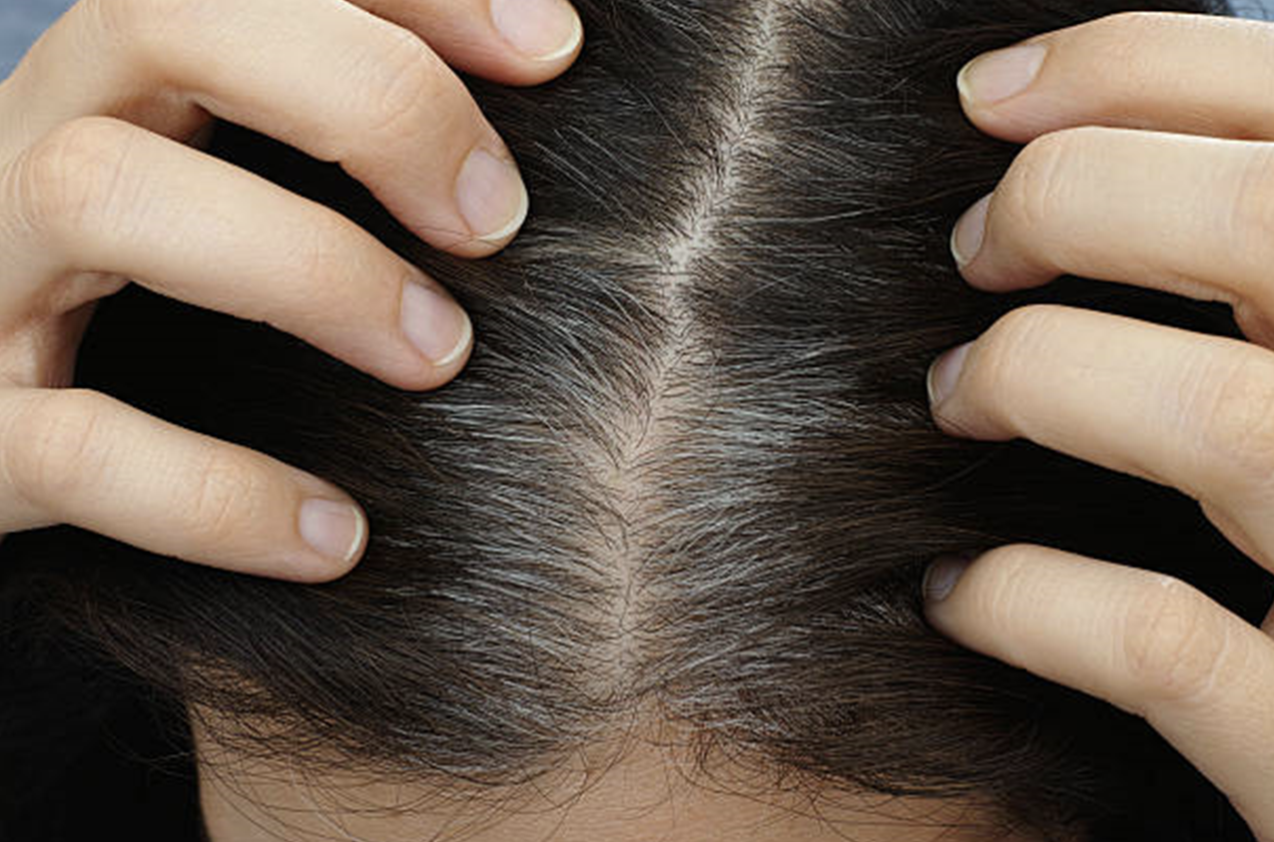 Why and How to Reverse Premature Greying?  