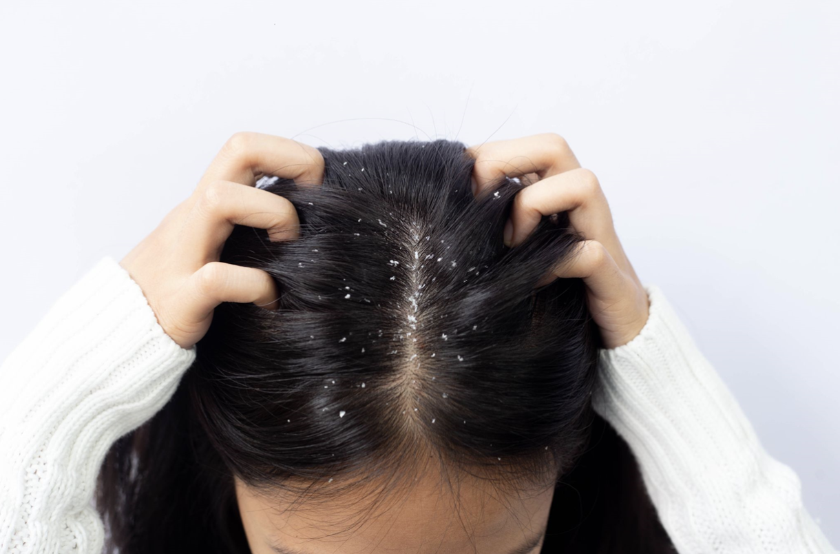 DIY Dandruff Solutions: A Guide to Home Remedies for a Flake-Free Scalp