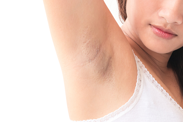 4 common underarm problems and solutions to deal with them