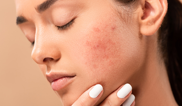 5 Anti-Inflammatory Ingredients To Soothe Irritated Skin