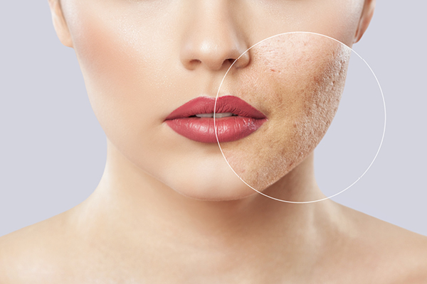 How To Manage Hyperpigmentation In The Summer?