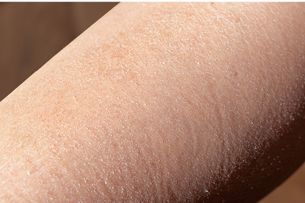 Laser hair removal side effects you need to be wary of