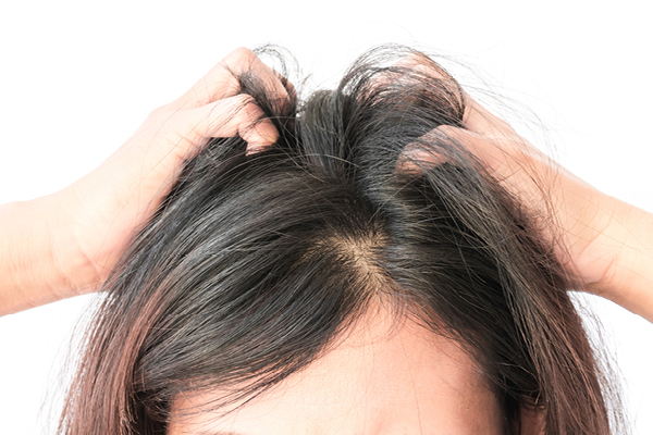 9 Home Remedies to Get Rid of Head Lice