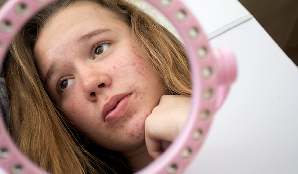 Pesky Pimples Embarrassing You? Here's How To Get Rid of Teenage Pimples Naturally