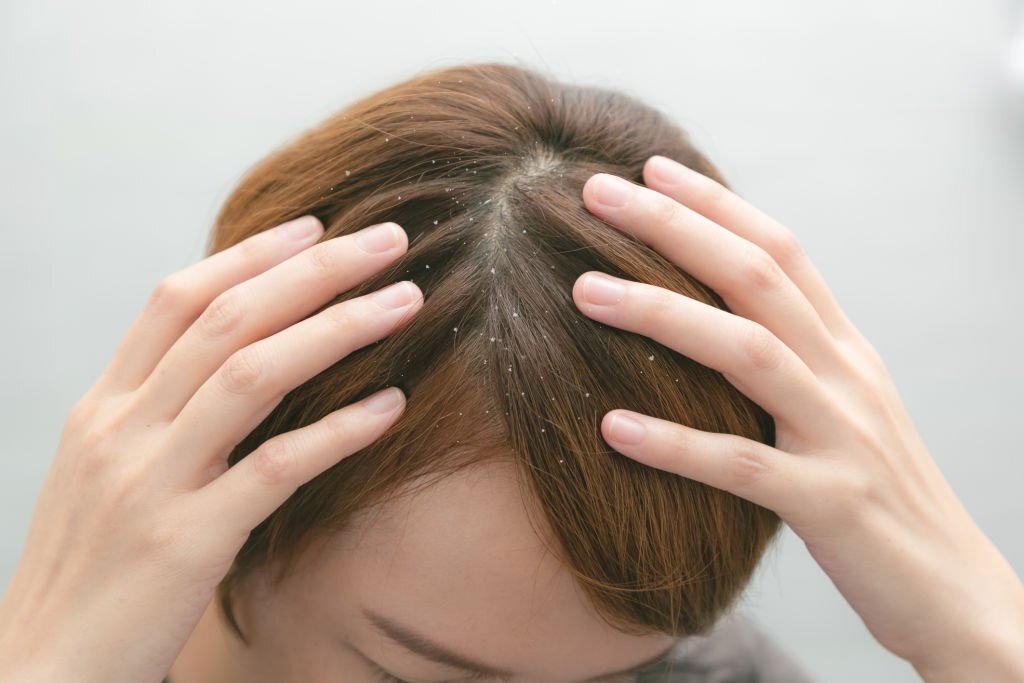 FAQs on hair fall caused by dandruff