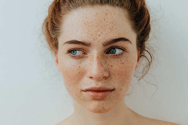 9 Expert Home Remedies For Freckles On The Face