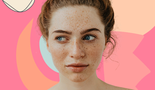 9 Expert Home Remedies For Freckles On The Face