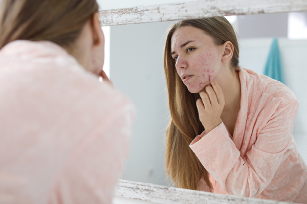 How to treat fungal face acne?