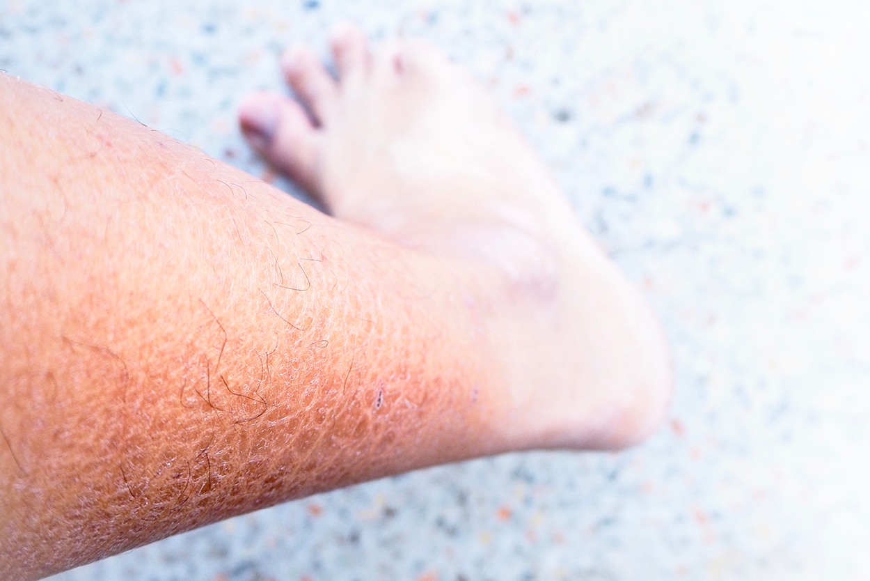 A dermatologist's guide on dealing with Ichthyosis Vulgaris