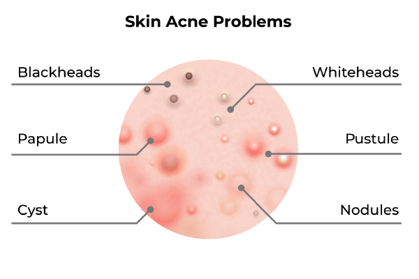 Struggling with cystic acne? Let a dermatologist explain how to deal ...