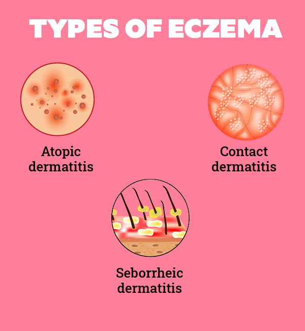 All You Need to Know About Eczema on Face