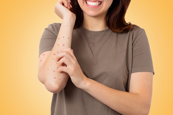 FAQs about scabies