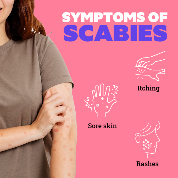 FAQs about scabies