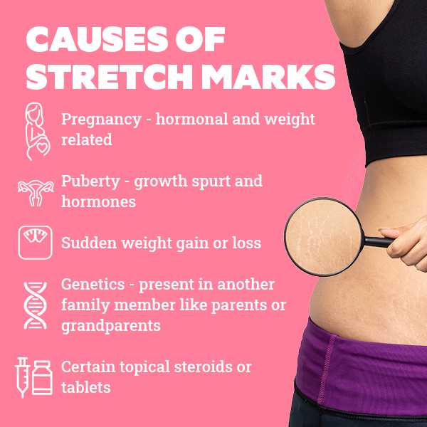 How to deal with stretch marks in teenagers, according to a