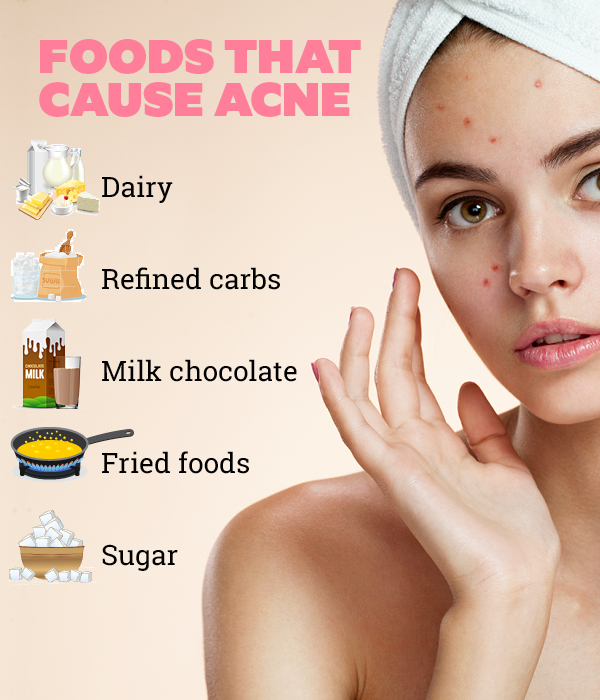 Anti-acne diet: How diet affects acne and what foods to eat & avoid