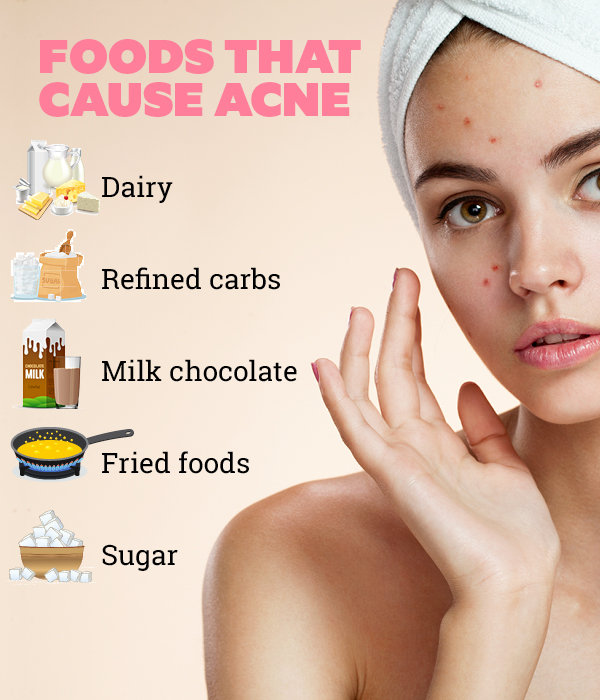 Basic skincare tips to prevent acne