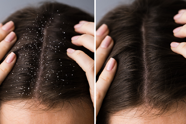 Coconut oil good 2024 for dandruff