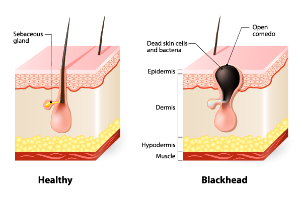 Best Solution to Prevent and Remove Blackheads | Top 5 FAQs about blackheads