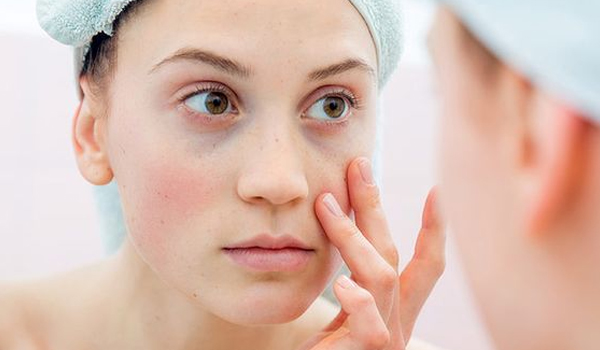 How to prevent and treat dark circles