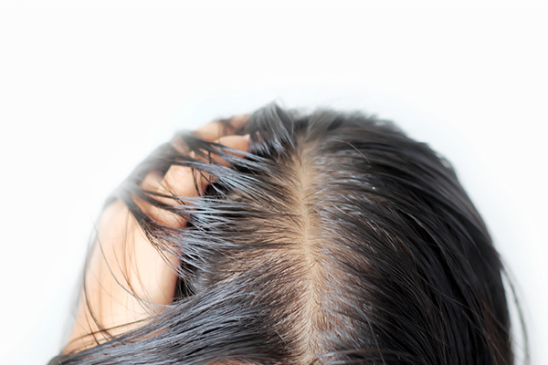 Does dandruff trigger acne? Let's investigate