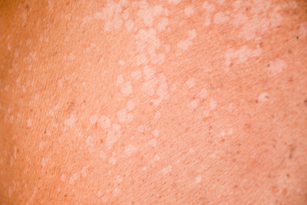 Everything You Need To Know About Pityriasis Versicolor