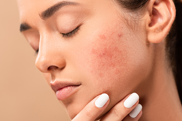 Here s Everything You Need To Know About Doxycycline For Acne