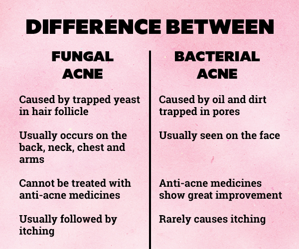 FAQs about fungal acne