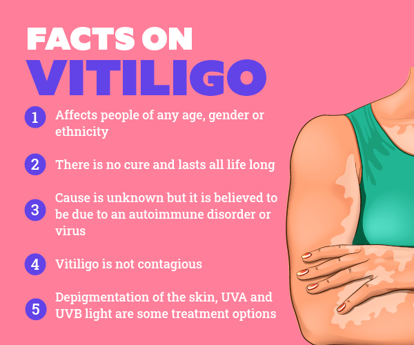 FAQs about vitiligo
