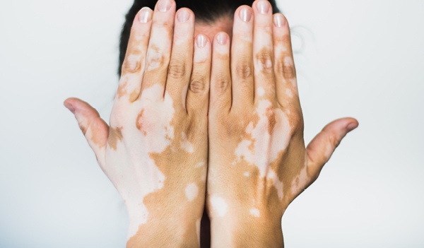 what is Vitiligo and best vitiligo treatments