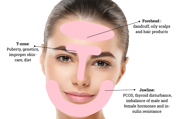 An expert's guide to face mapping for acne and tips to deal with breakouts