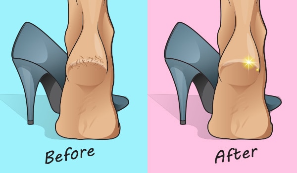 Say goodbye to cracked heels with these easy home remedies