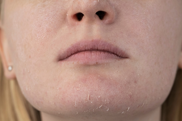 FAQs about skin peeling on face