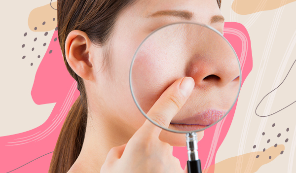  How to deal with redness around the nose 