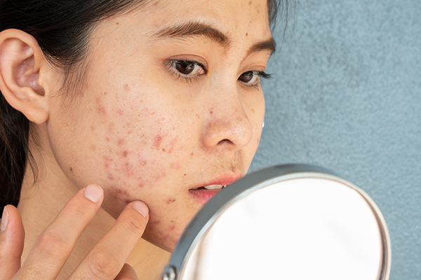 FAQs about pregnancy acne