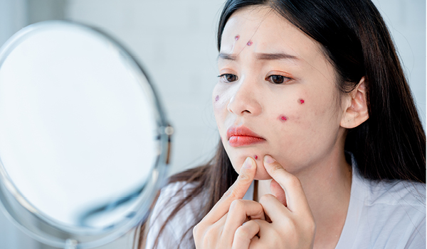 An Expert’s Guide On Safely Treating Pimples During Pregnancy