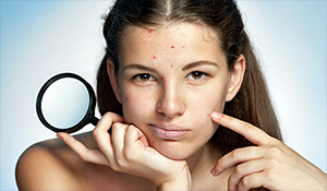 Is acne troubling you? Follow this skincare routine to keep acne at bay...