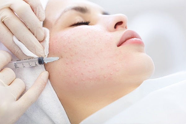 Microneedling 101: Here's everything you need to know about this