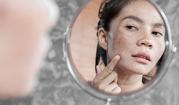 How to Remove Spots From Your Face in 2 Days Naturally?