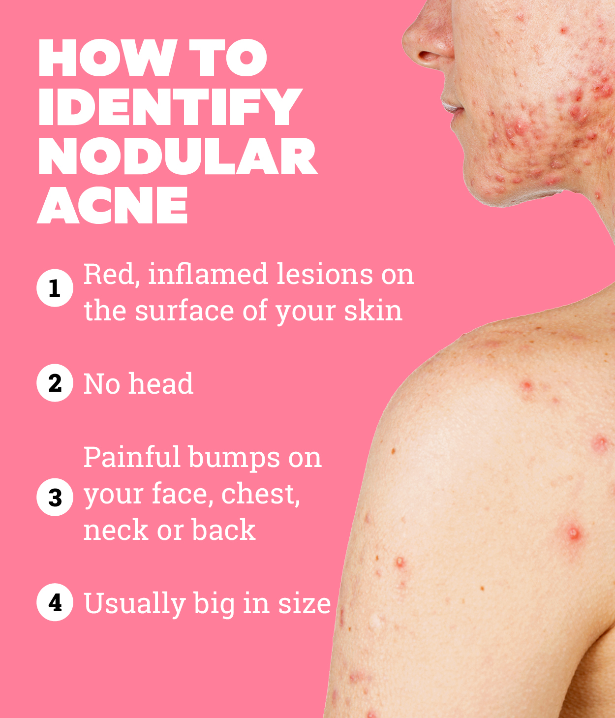 Nodular acne outlet