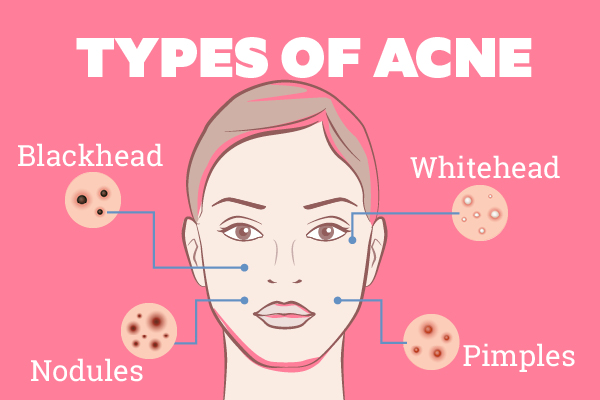 Act on the Acne Attack: Best Overnight Home Remedy for Acne