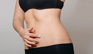 4 home remedies to prevent stretch marks 