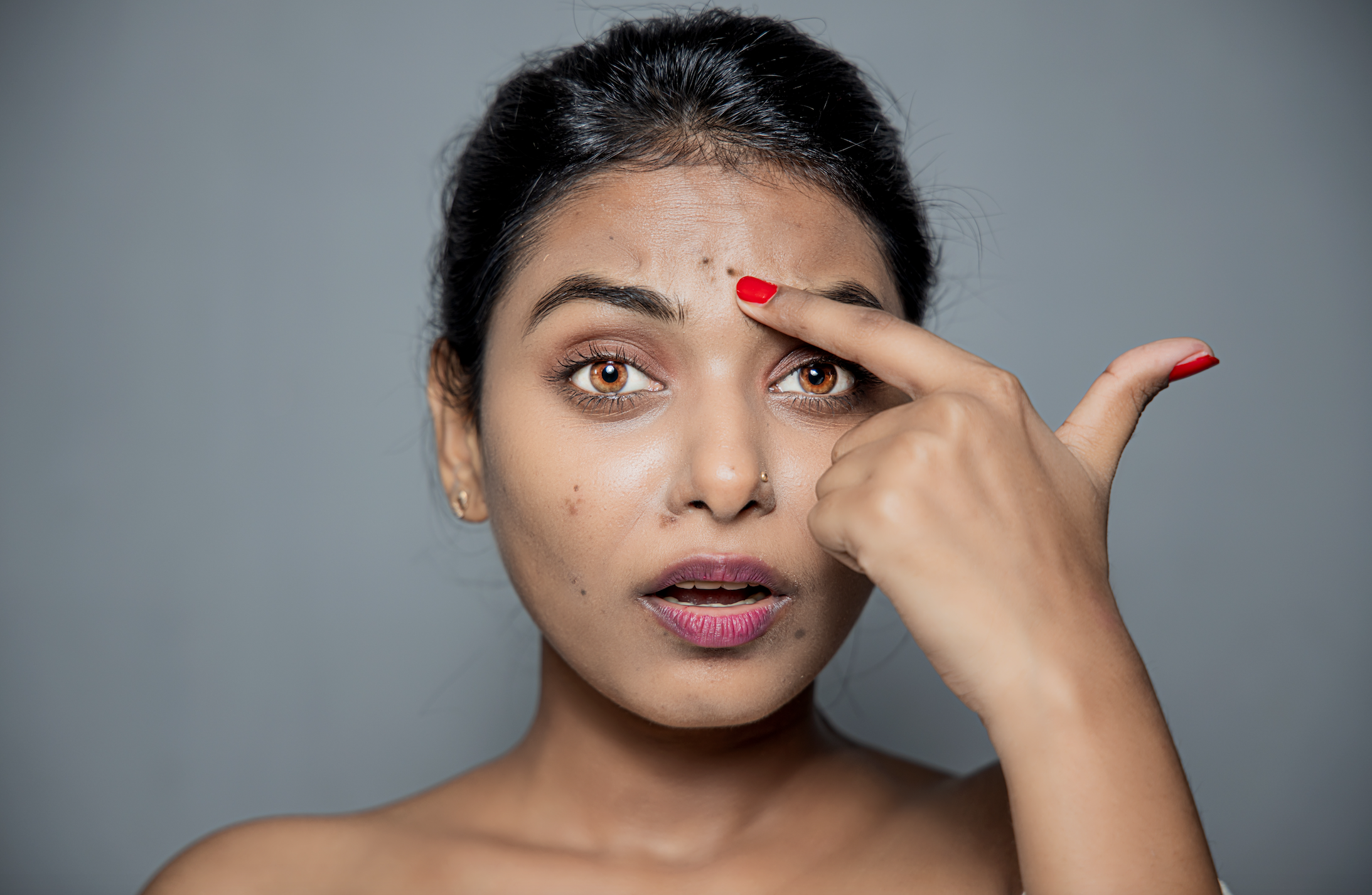 How to Remove Dark Spots Caused by Pimples: Dermatologist Explains