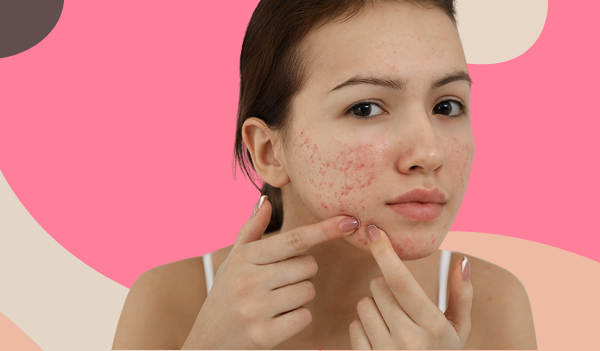 Easy Home Remedies To Fade Scars Naturally | Femina.in