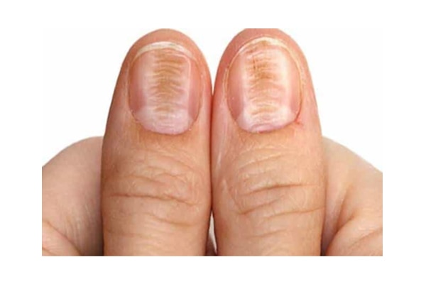 What Do These Lines On Your Nails Tell You About Your Health? - Mental Scoop