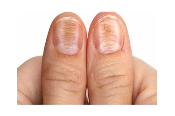 What It Really Means When Ridges Appear On Your Nails