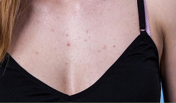 What causes chest acne — and how to deal with it