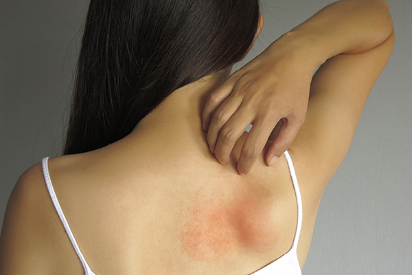 What is a stress rash How to manage hives caused by anxiety