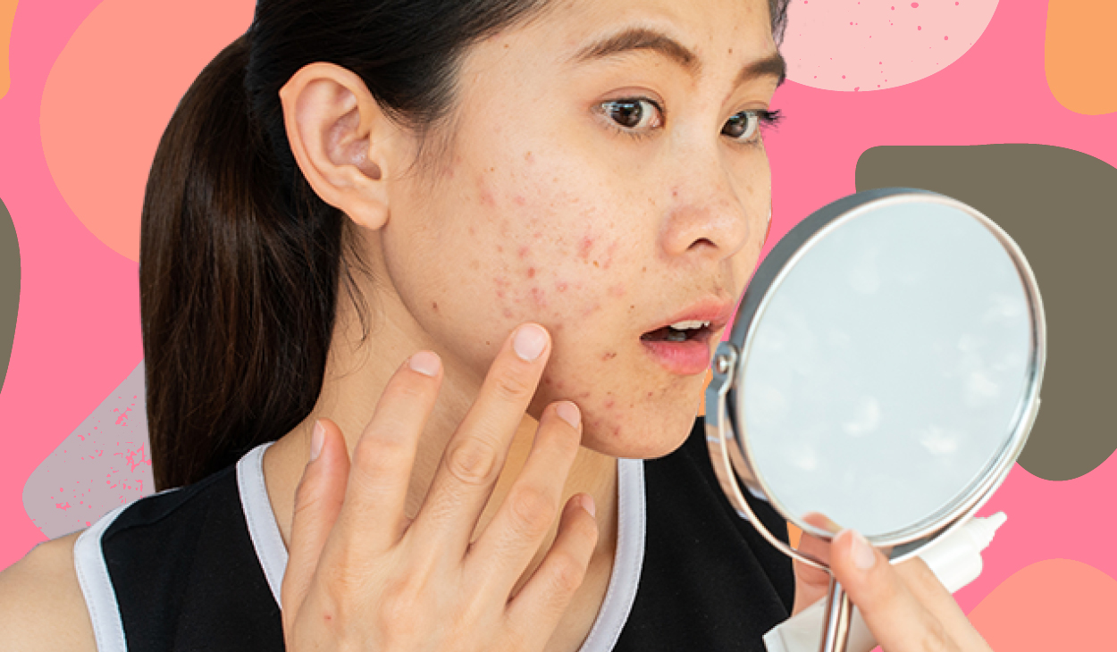 Want to take care of acne-prone skin? Clean beauty is your answer