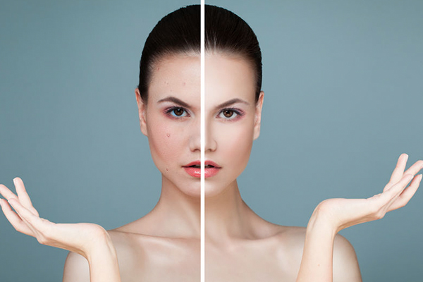 4 common skin concerns that can be treated using benzoyl peroxide