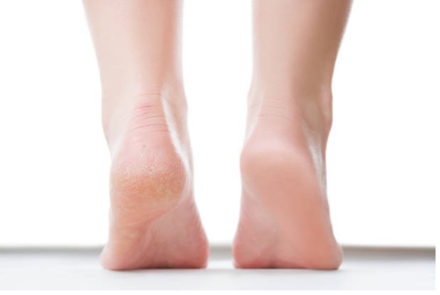Heel Magic | Dry heel treatment | Dermal Therapy